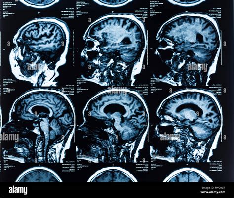 Head MRI (Magnetic Resonance Imaging) .